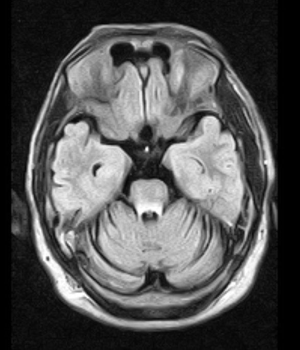 wernicke encephalopathy