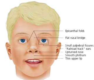 Health Information Down Syndrome Due To Excess Chromosome Conditions