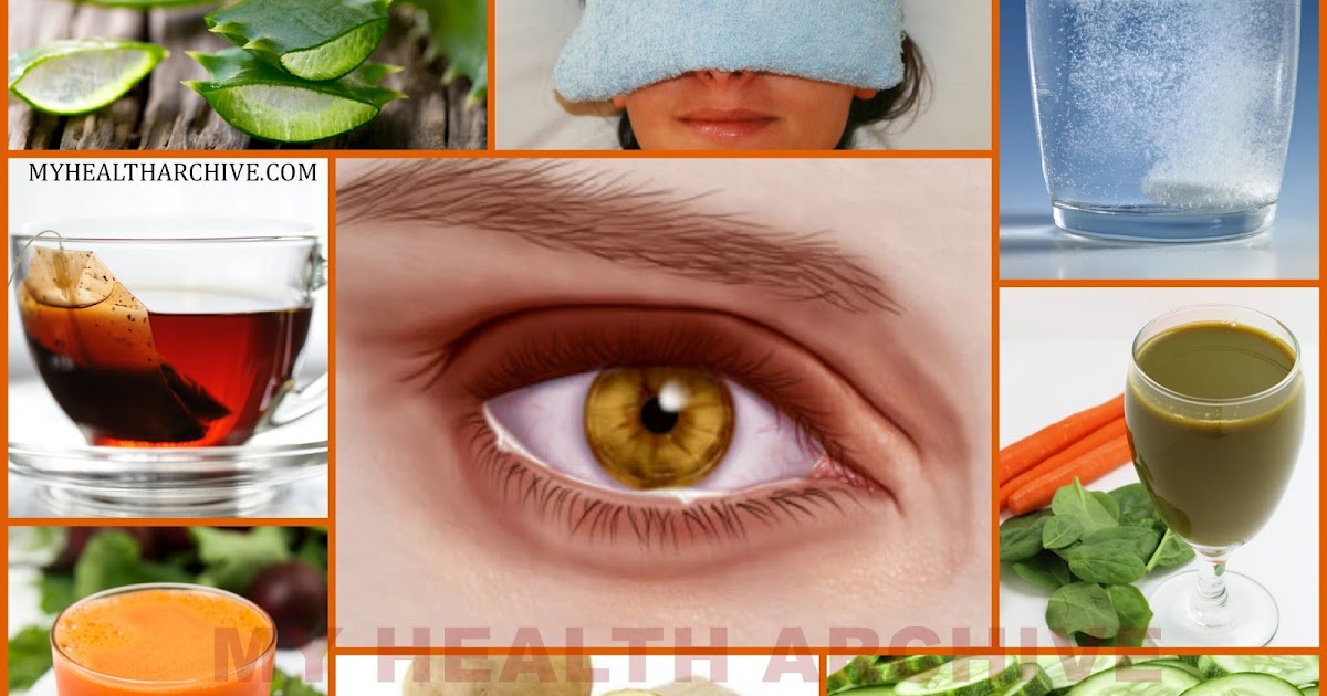 Is there a home remedy cure for watery eyes?