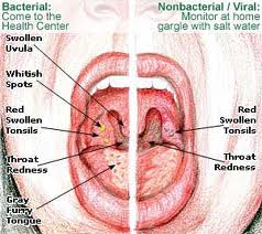 Home Care Tonsillitis