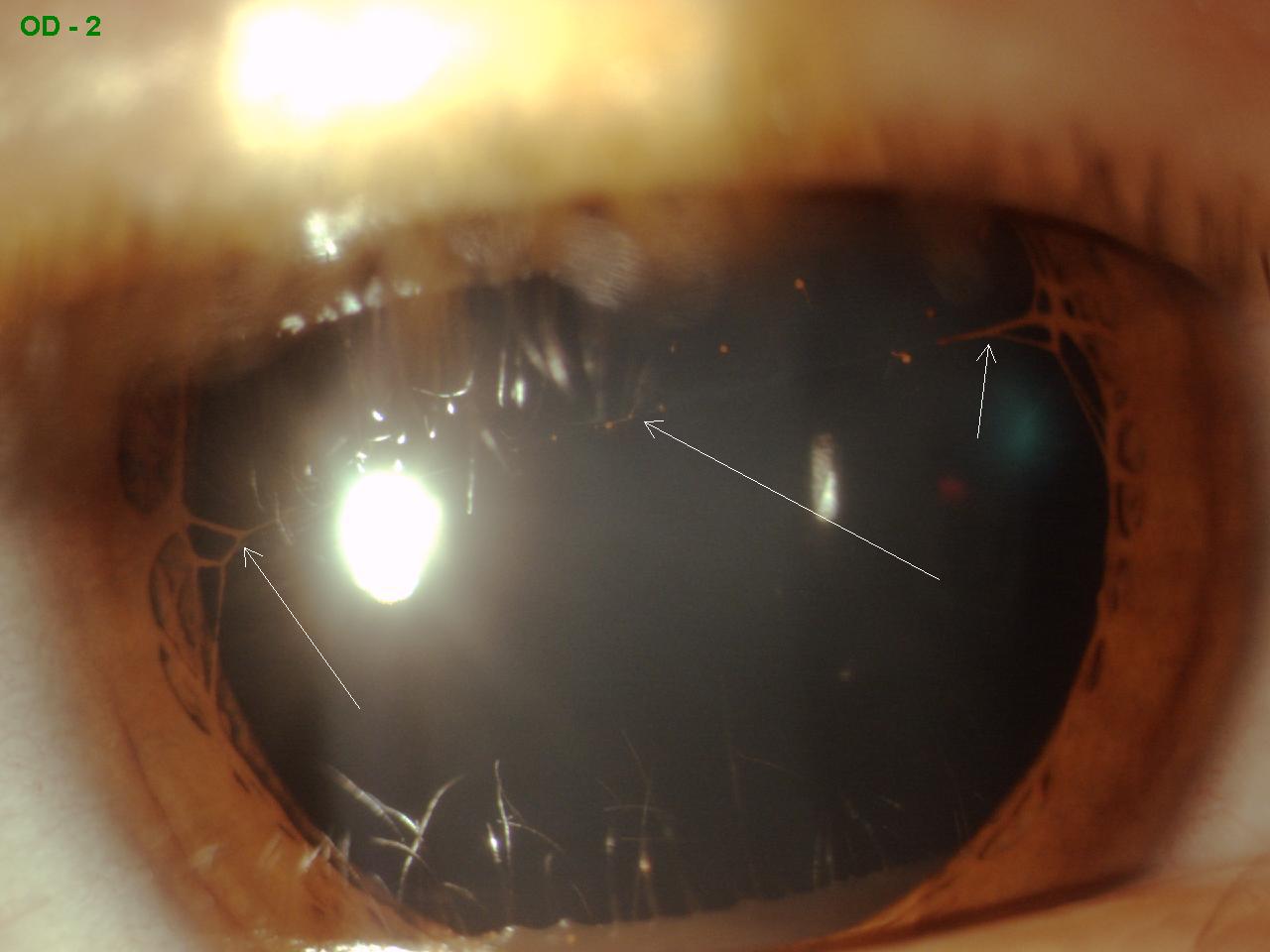 IRIS STRAND Sonoran Desert Eye Center