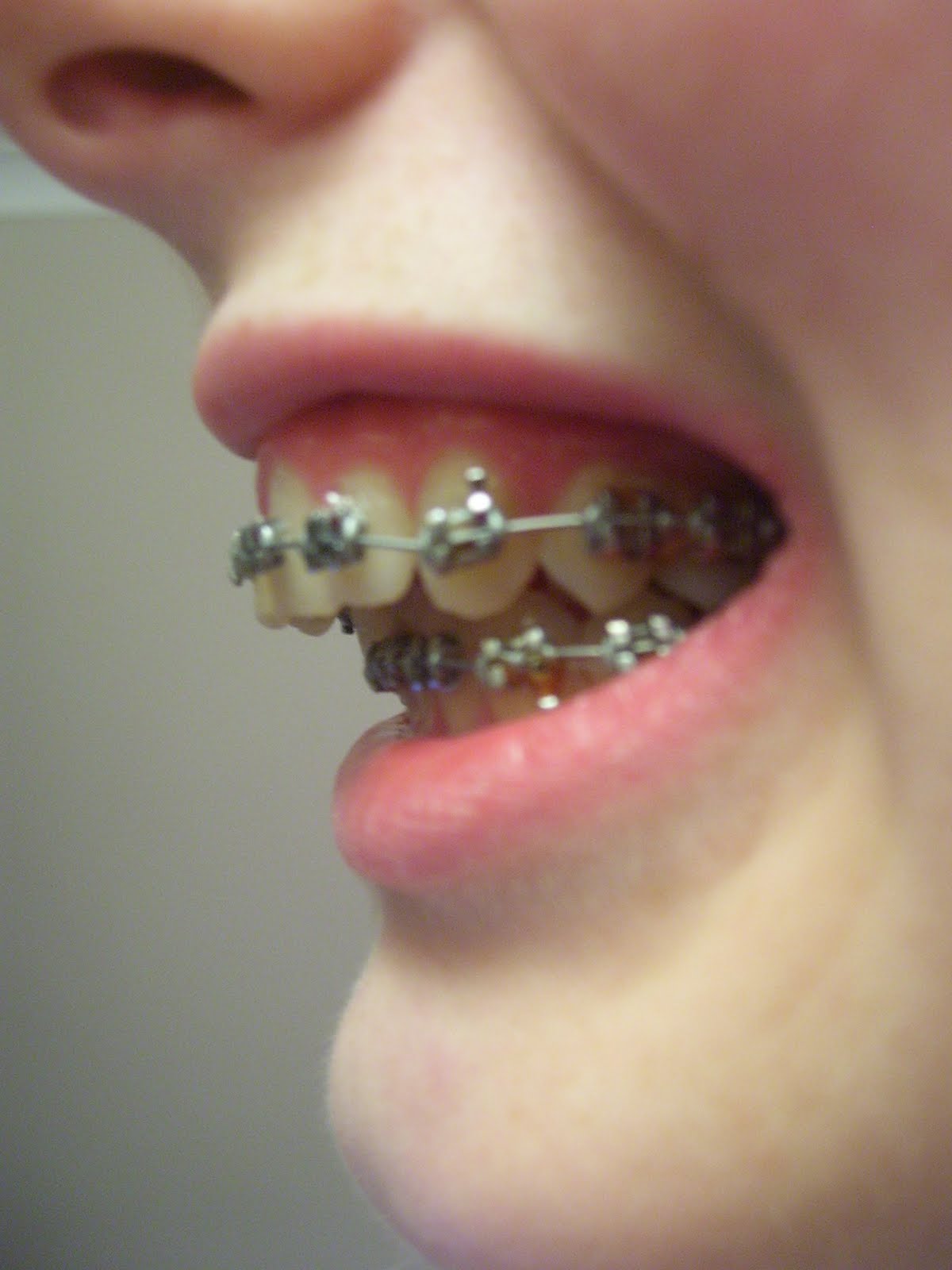 Will Braces Stop Jaw Popping at Paul Casey blog