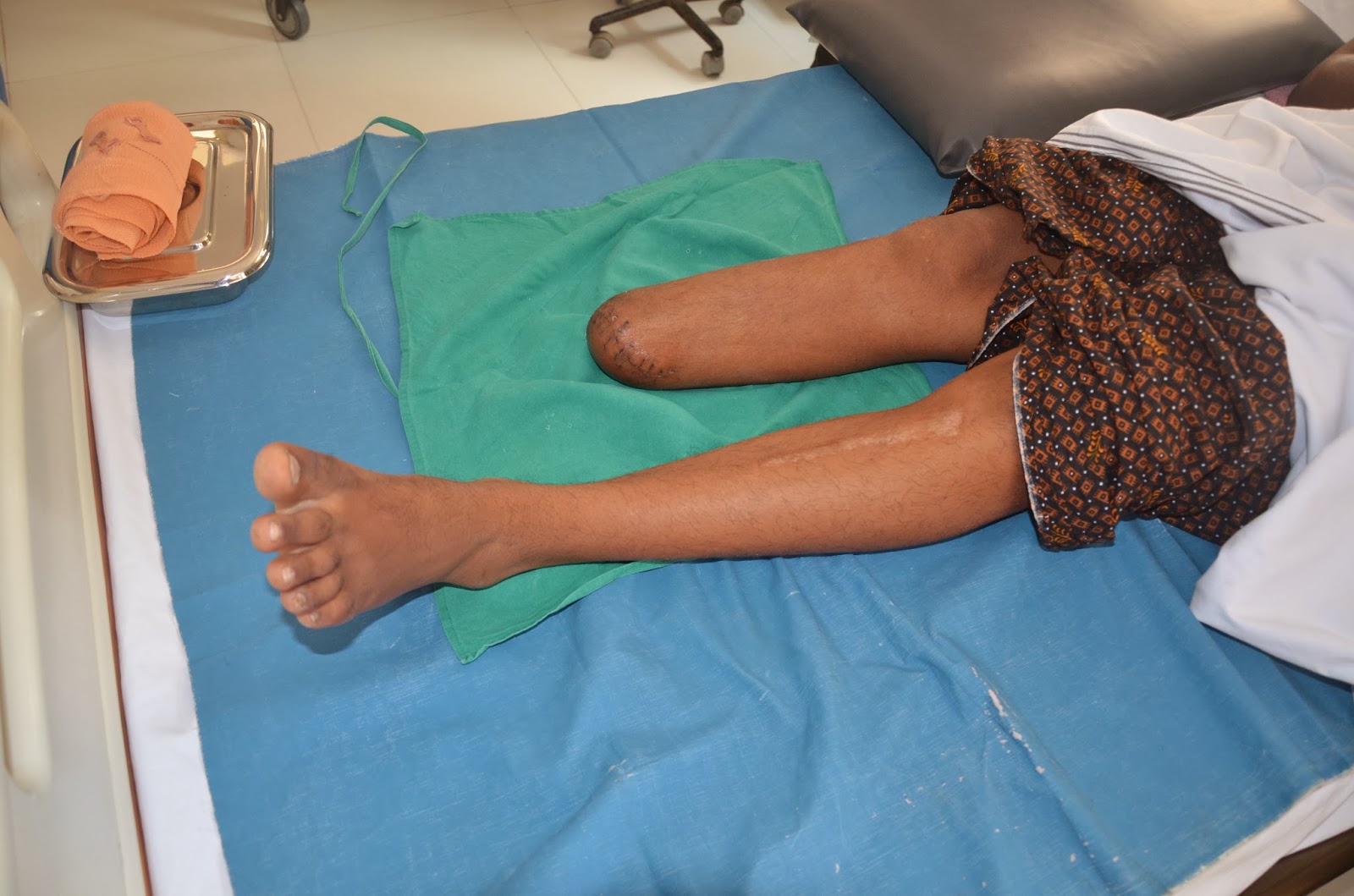 CRUSH INJURY FOOT WITH BONE LOSS AND NERVE INJURY BELOW KNEE