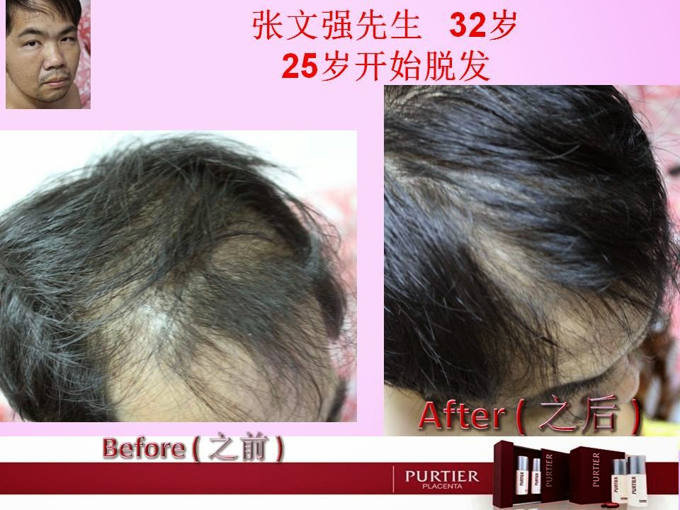 MR CHEONG (32 YEARS OLD) - DURING 25TH YEARS OLD START SHEDDING HAIR