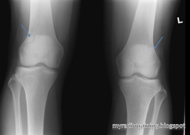 Radiology info hub Normal Variant Bipartite Patella
