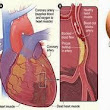 Cara Mencegah Serangan Jantung