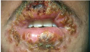 Herpes Pada Mulut