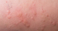 picture of Hives