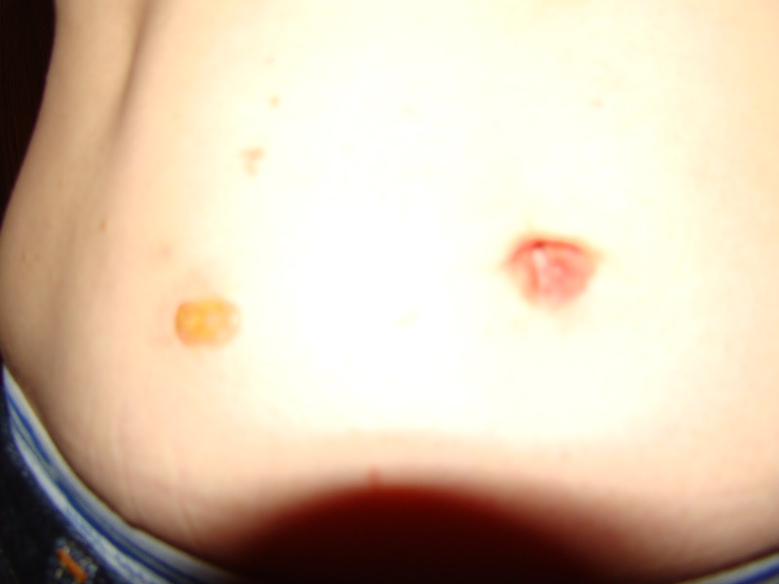 Warts On Stomach