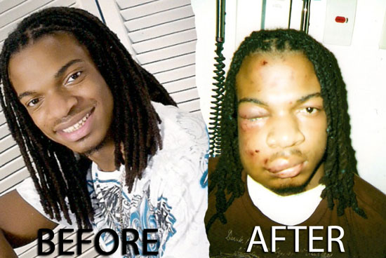 Jordan Miles, before and after Pittsburgh Police beating @justice4jordan