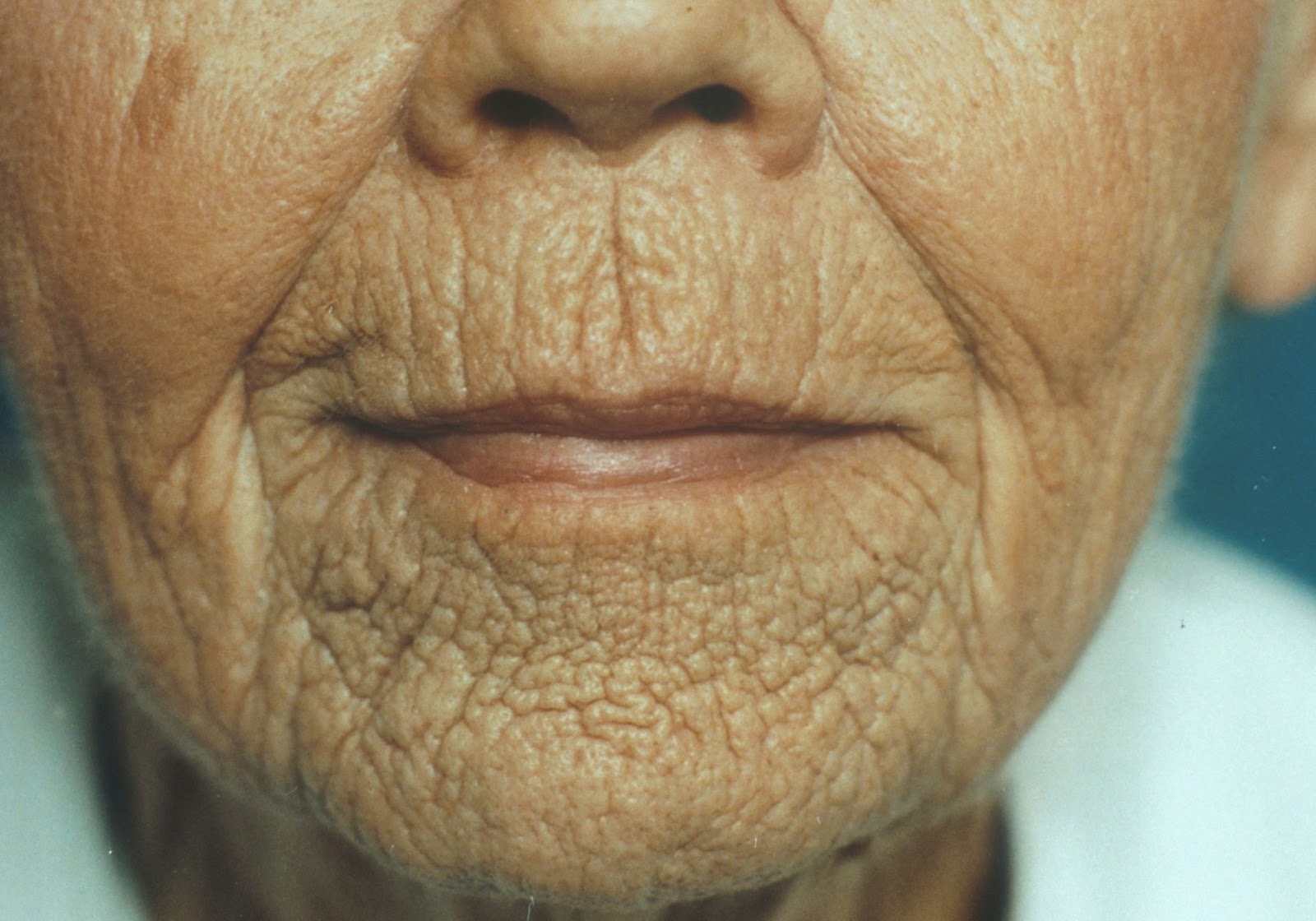 facial wrinkles Deep