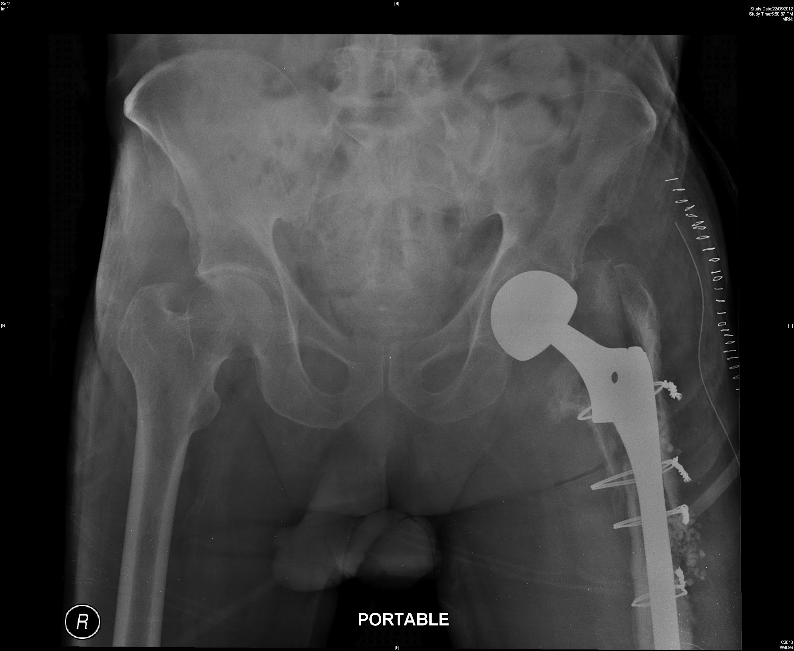 Ankle Fracture Types Hap with antibiotics packed in at osteotomy sites and gaps proximally-1.bp.blogspot.com