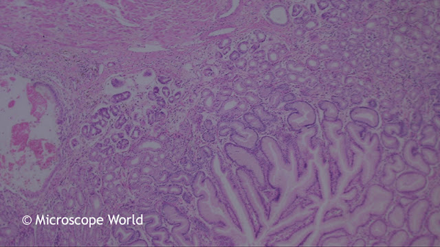 Colon polyp image under the microscope at 40x.