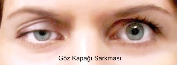 Goz Kapagi Sarkmasi Neden Olur Guzellik Haberleri