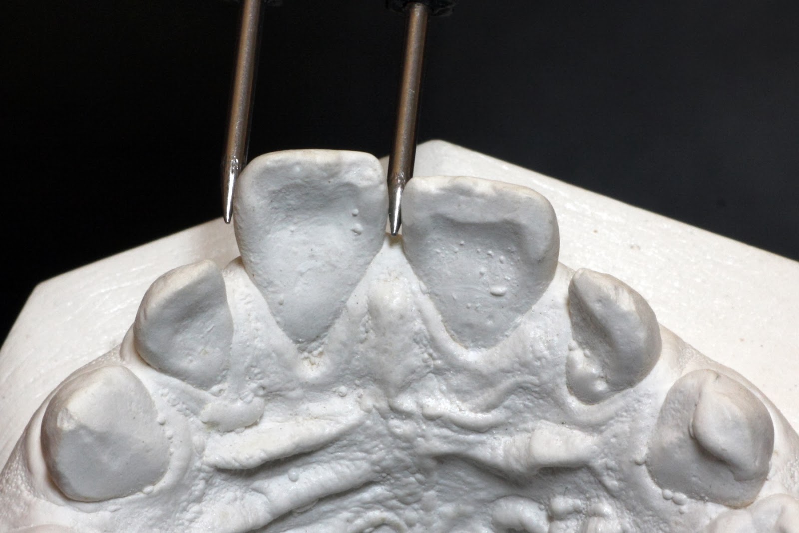 Orthodontics UG Model Analysis Tooth width measurement
