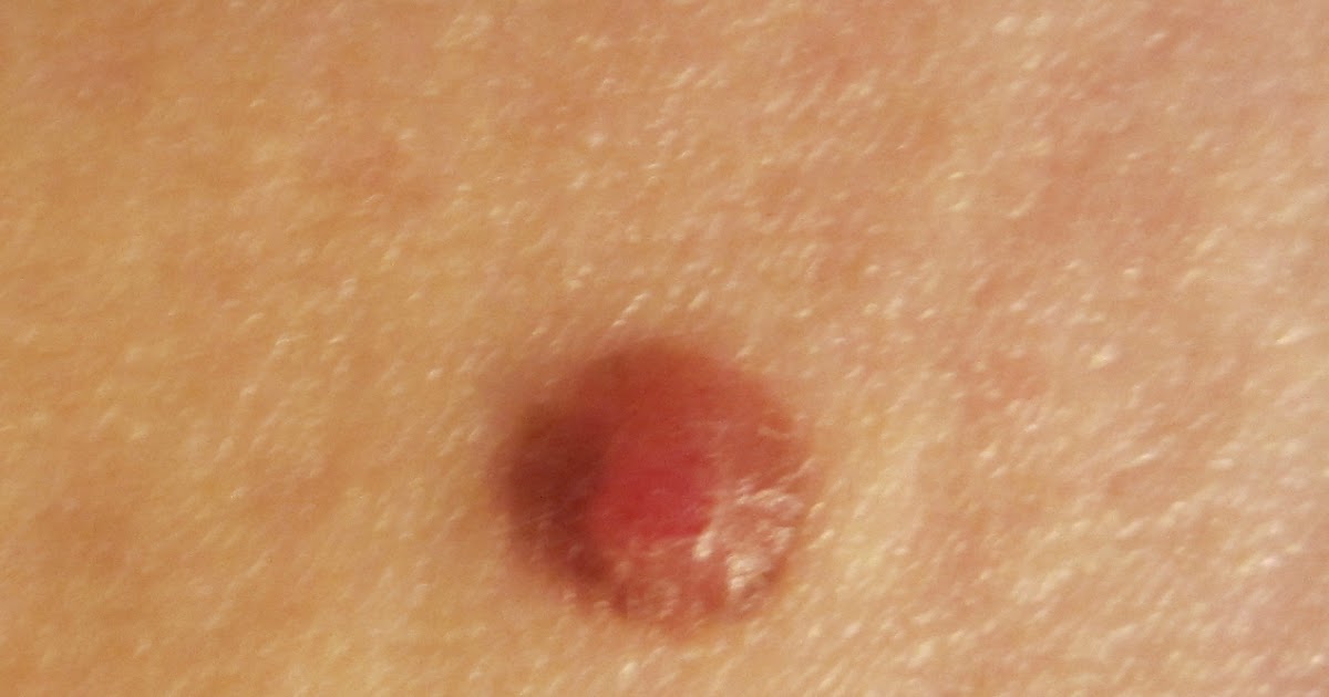 Melanoma My Pain In the Bum! Shoulda Woulda Coulda...