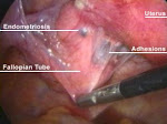 WAA MAXAY ENDOMETRIOSIS YUU KU DHACAA MALA ISKA QALI KARAA CUDURKAAN