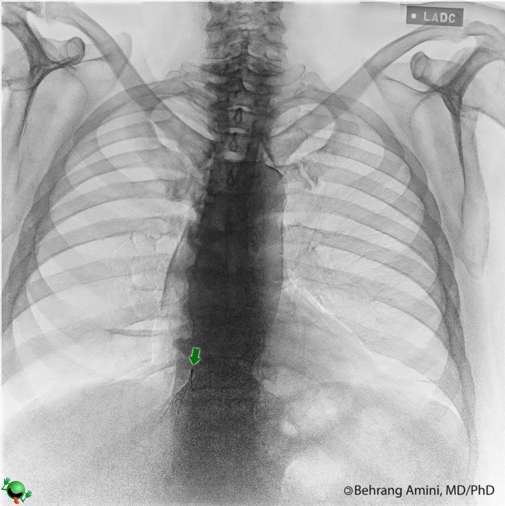 Roentgen Ray Reader Suprarenal Inferior Vena Cava Filter Placement