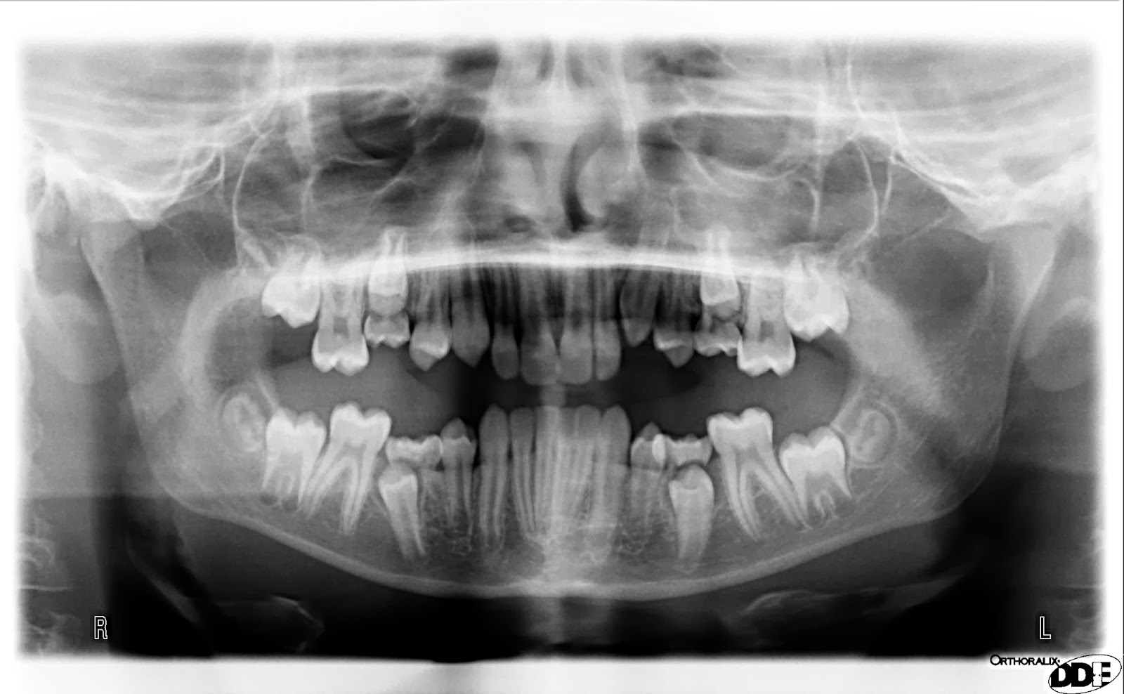 Wetherby Orthodontics, Our Blog Submerging deciduous teeth and the