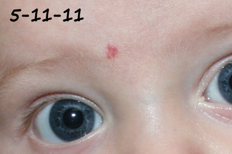 B's Hemangioma