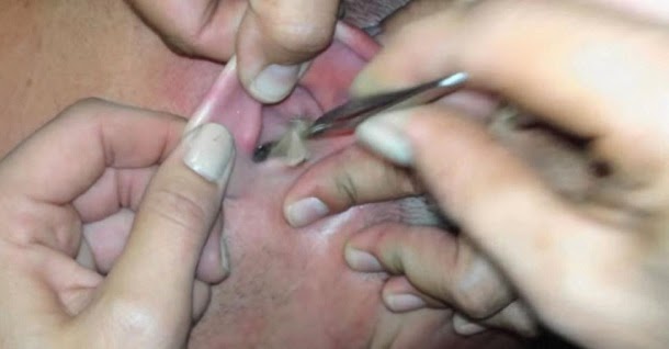 Parasita em um corpo humano na cabeça