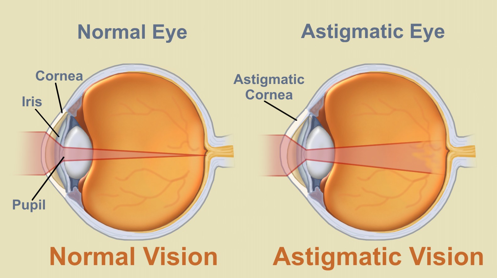 What are contacts for astigmatism?