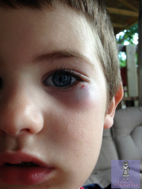 kids black eye, frisbee injury, canada day fun, kids hurt