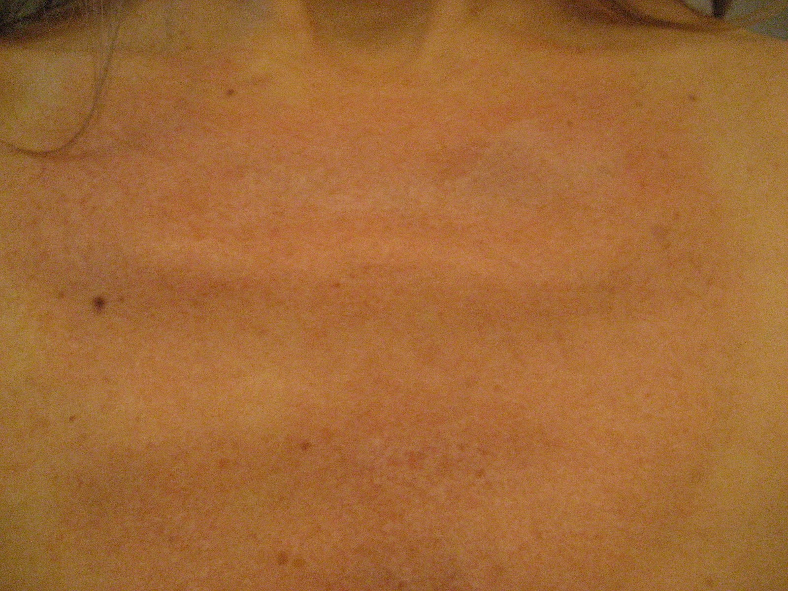 Chemical Peels for Acne and Anti Aging Should I prep before my TCA Peel?