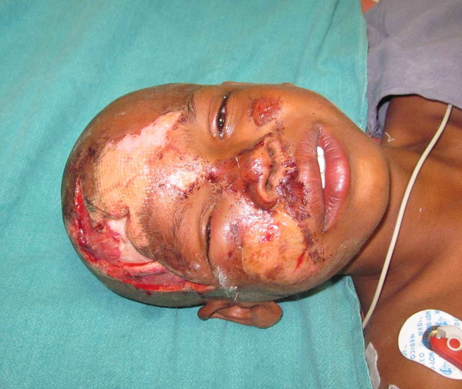 Avulsion Wound