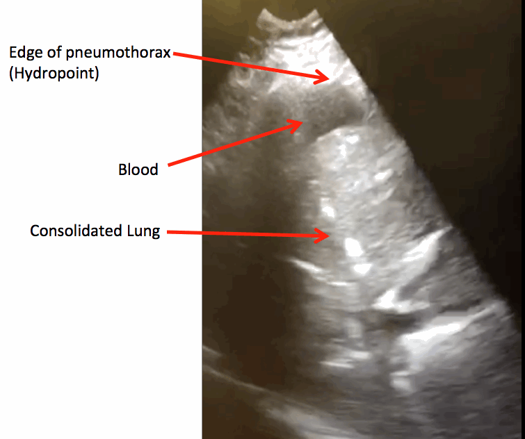 HydroPoint Ultrasound sign of airfluid level in the pleura