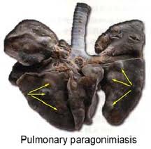 pulmones afectados de paragonimiasis se ven bultos en los pulmones, que son los trematodos