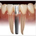 É possível o organismo rejeitar um implante dentário colocado?