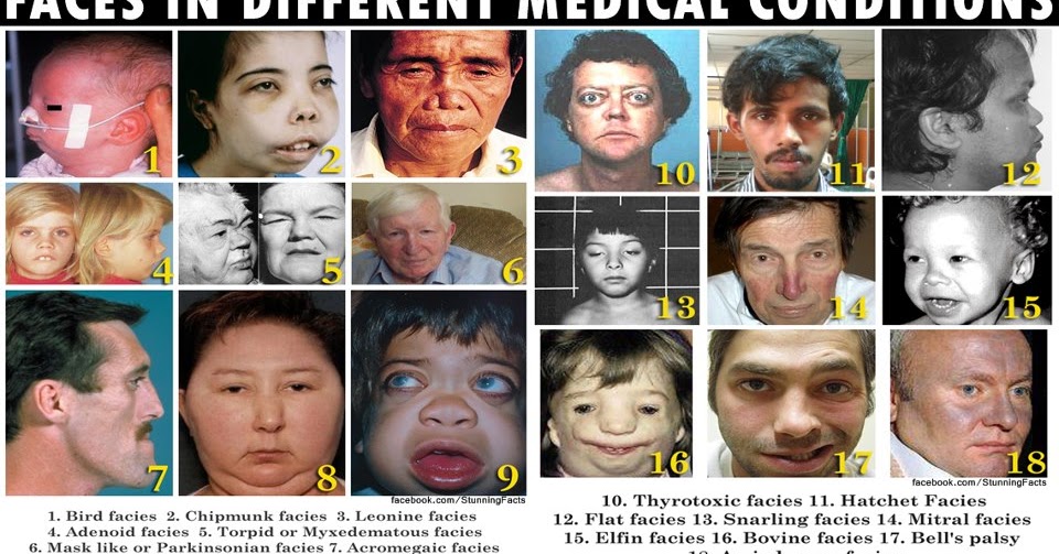 FACES IN DIFFERENT MEDICAL CONDITIONS Stunning Interesting Facts