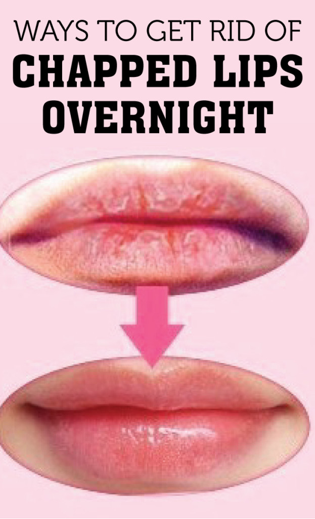 Ways to Get Rid of Chapped Lips Overnight World of Women Style and Fashion