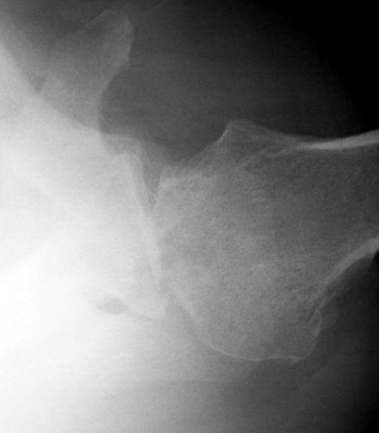 Shoulder Arthritis / Rotator Cuff Tears causes of shoulder pain The