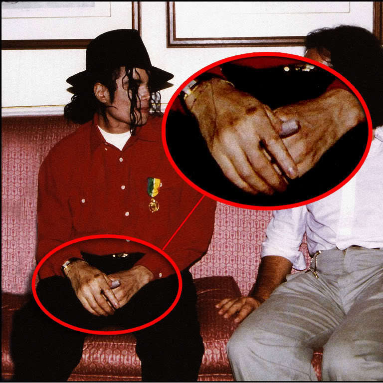 MJ-s-vitiligo-michael-jackson-11957264-768-768.jpg