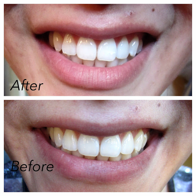 Fashion, Makeup and More First Impressions Crest 3D White Strips