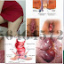 Obat Wasir (Hemoroid) Yang Dapat dibeli Di Apotek thumbnail