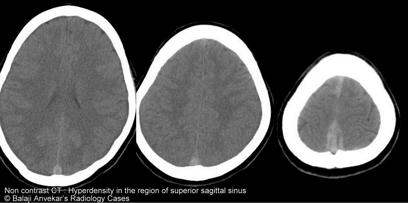 Dr Balaji Anvekar FRCR: Hyperdense sinus on CT Brain