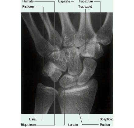 Carpal bones arrangement - anatomy and mnemonic ~ Medicine Hack
