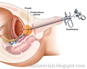 prostat prostat neden büyür