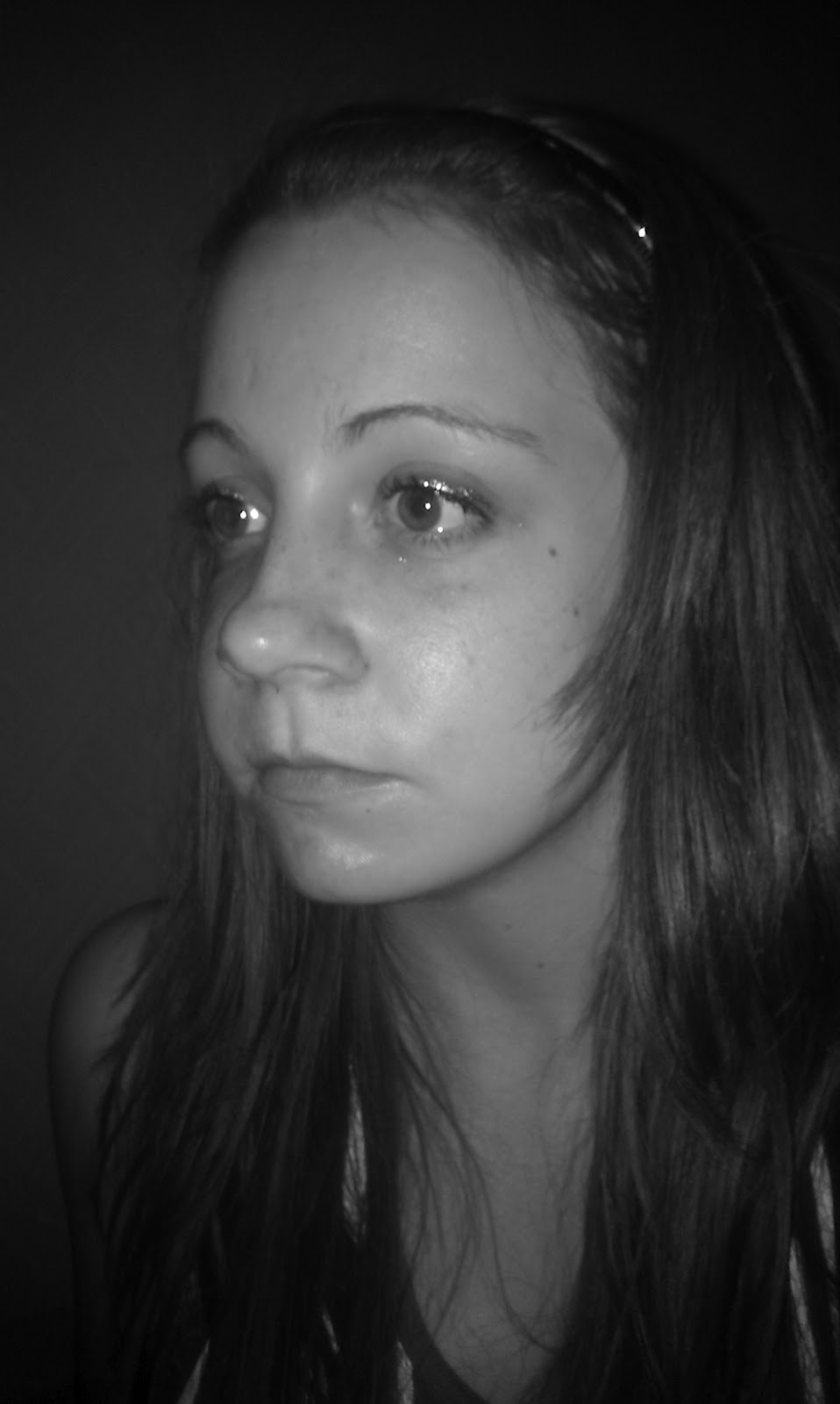 EmBracing Upper and Lower Jaw Surgery Day 406 Fat Face Returns......