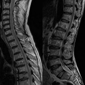 myeloma ct spine