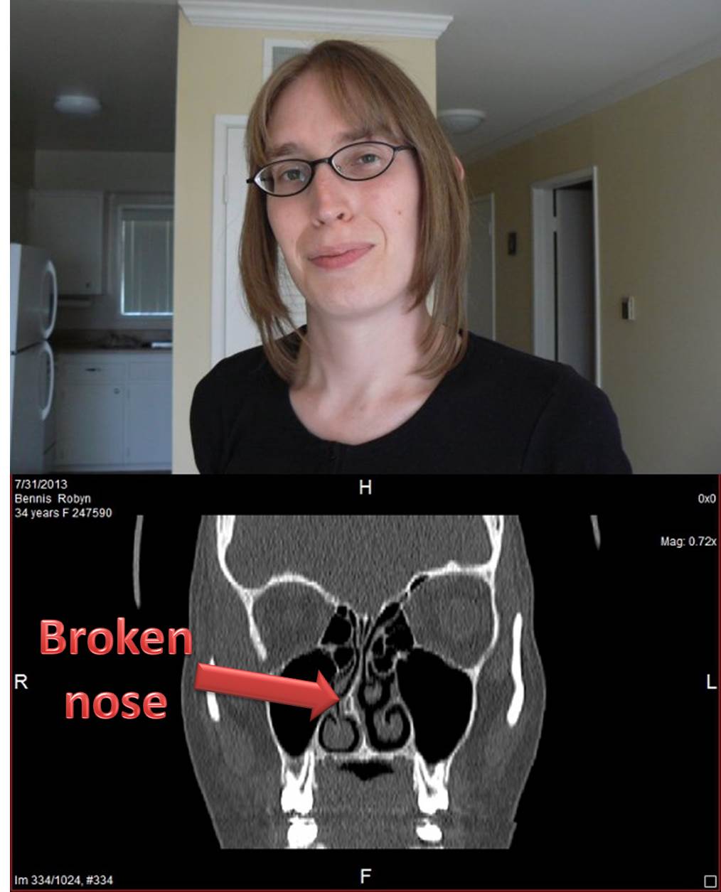 List 103+ Pictures Pictures Of A Broken Nose Completed 10/2023