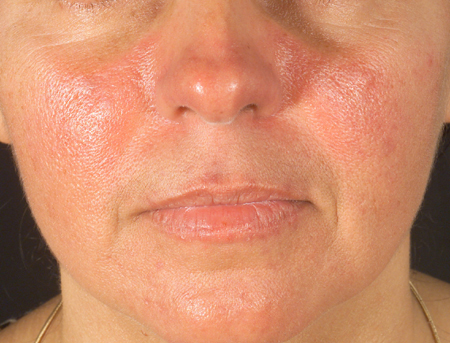 lupus and sun sensitivity