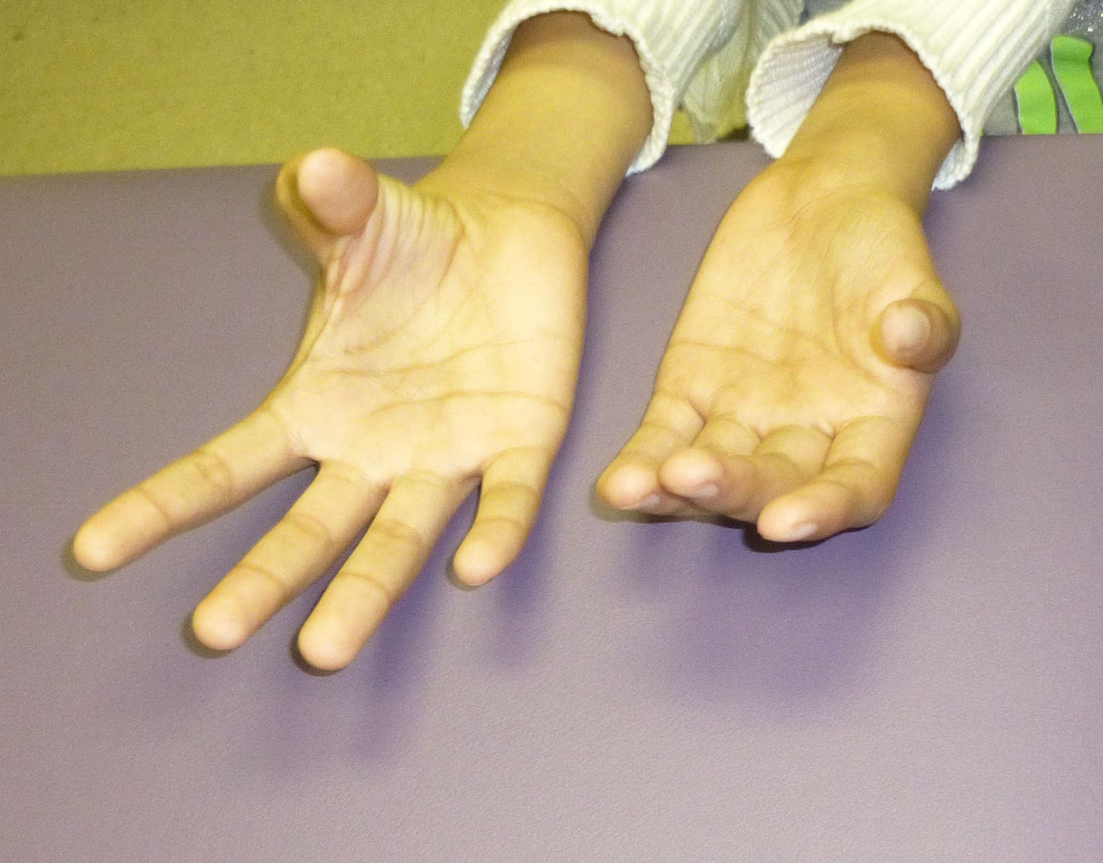 Small thumbs Congenital Hand and Arm Differences Washington University in St. Louis
