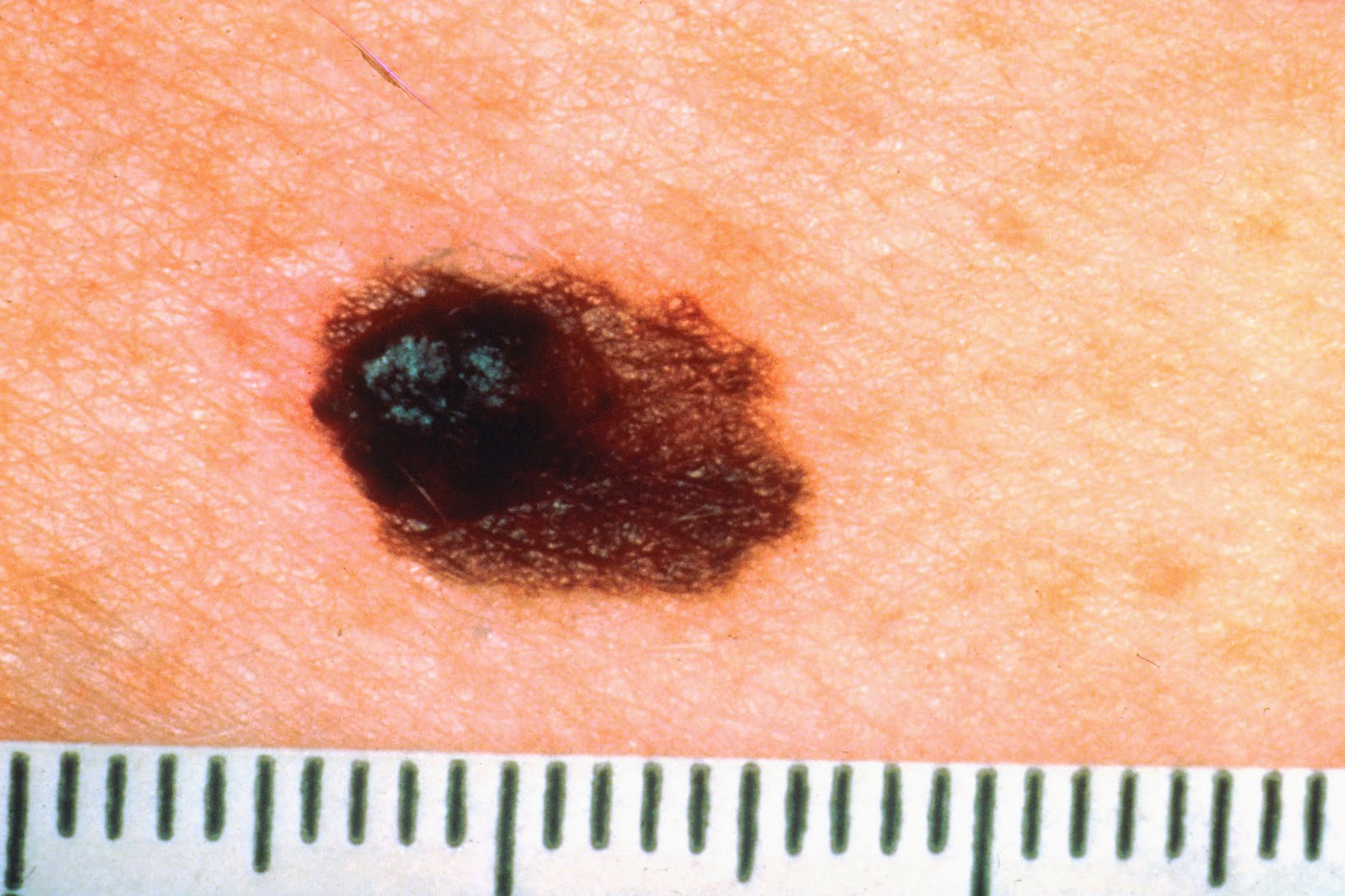 Estomatologia Online Melanoma Oral