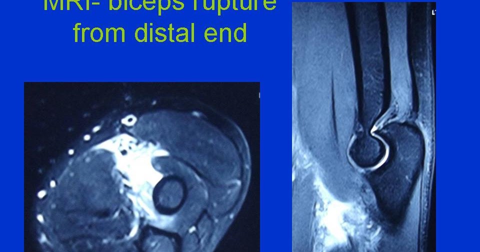 MRI Musculo-Skeletal Section: Biceps injury