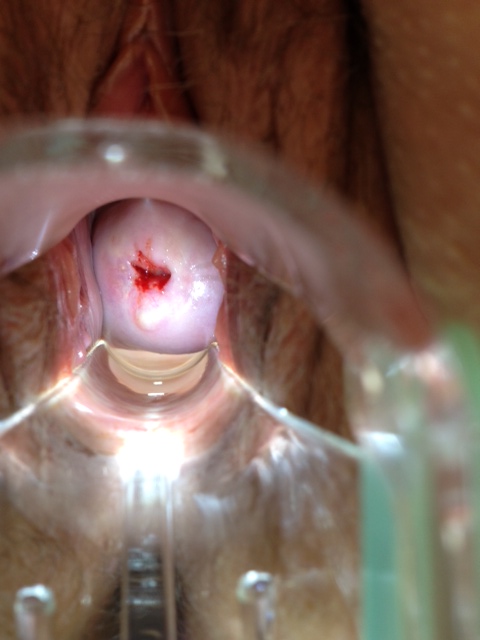 Suburethral Cyst