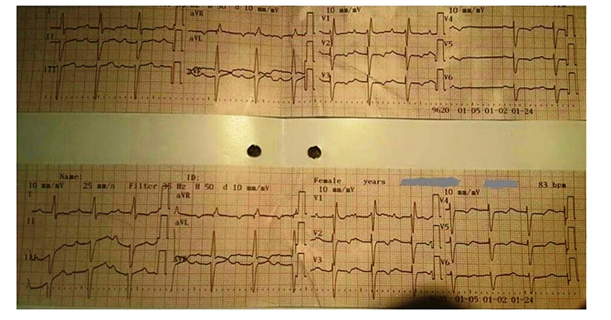 ECG Rhythms A case of trifascicular Block by Dr. Tính Nguyễn Chí